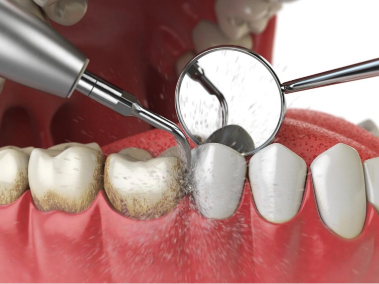 Scaling & Gum Treatment